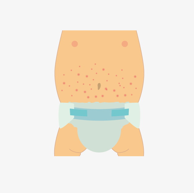 Cartoon Baby Belly Eczema, Cartoon Belly, Abdominal Eczema, Children Eczema Png Image And - Baby Belly, Transparent background PNG HD thumbnail