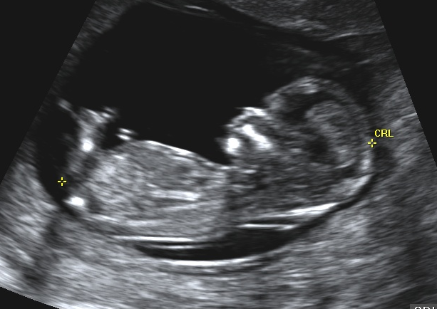 Cute baby ultrasound with suc
