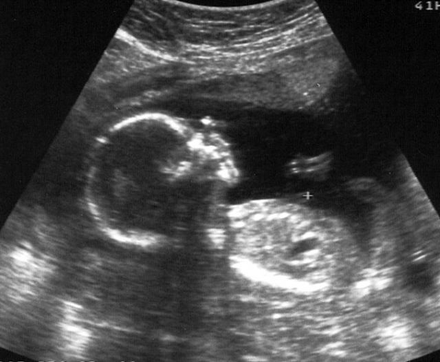 18 Weeks Baby Ultrasound Scanning.png - Baby Ultrasound, Transparent background PNG HD thumbnail
