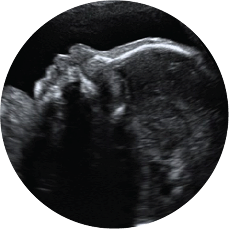 2D Ultrasound Image. 3D Ultrasound Image - Baby Ultrasound, Transparent background PNG HD thumbnail