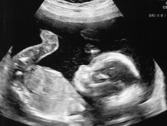 Ultrasound Image Fetus Icon, 