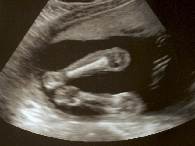Baby Legs Ultrasound.png - Baby Ultrasound, Transparent background PNG HD thumbnail