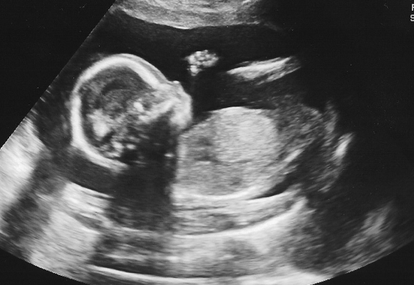 Baby profile sonogram ultrasound.PNG, Baby Ultrasound PNG - Free PNG