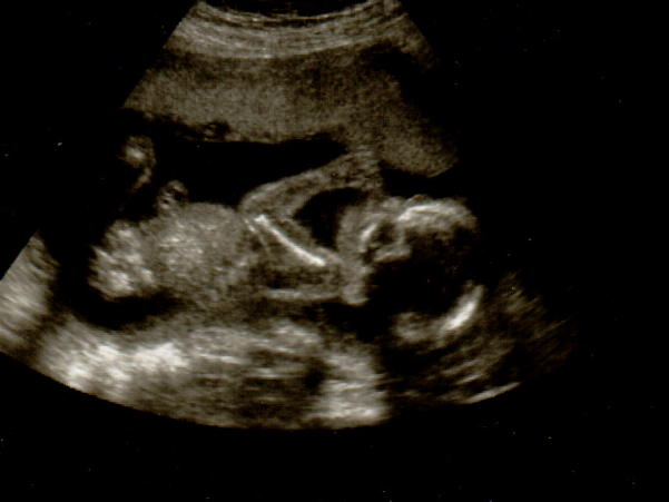 Baby Sucking Thumb Ultrasound Photo.png - Baby Ultrasound, Transparent background PNG HD thumbnail
