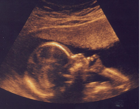 Ultrasound of baby body in mo