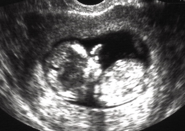 Cute Baby Ultrasound With Sucking Thumb.png - Baby Ultrasound, Transparent background PNG HD thumbnail