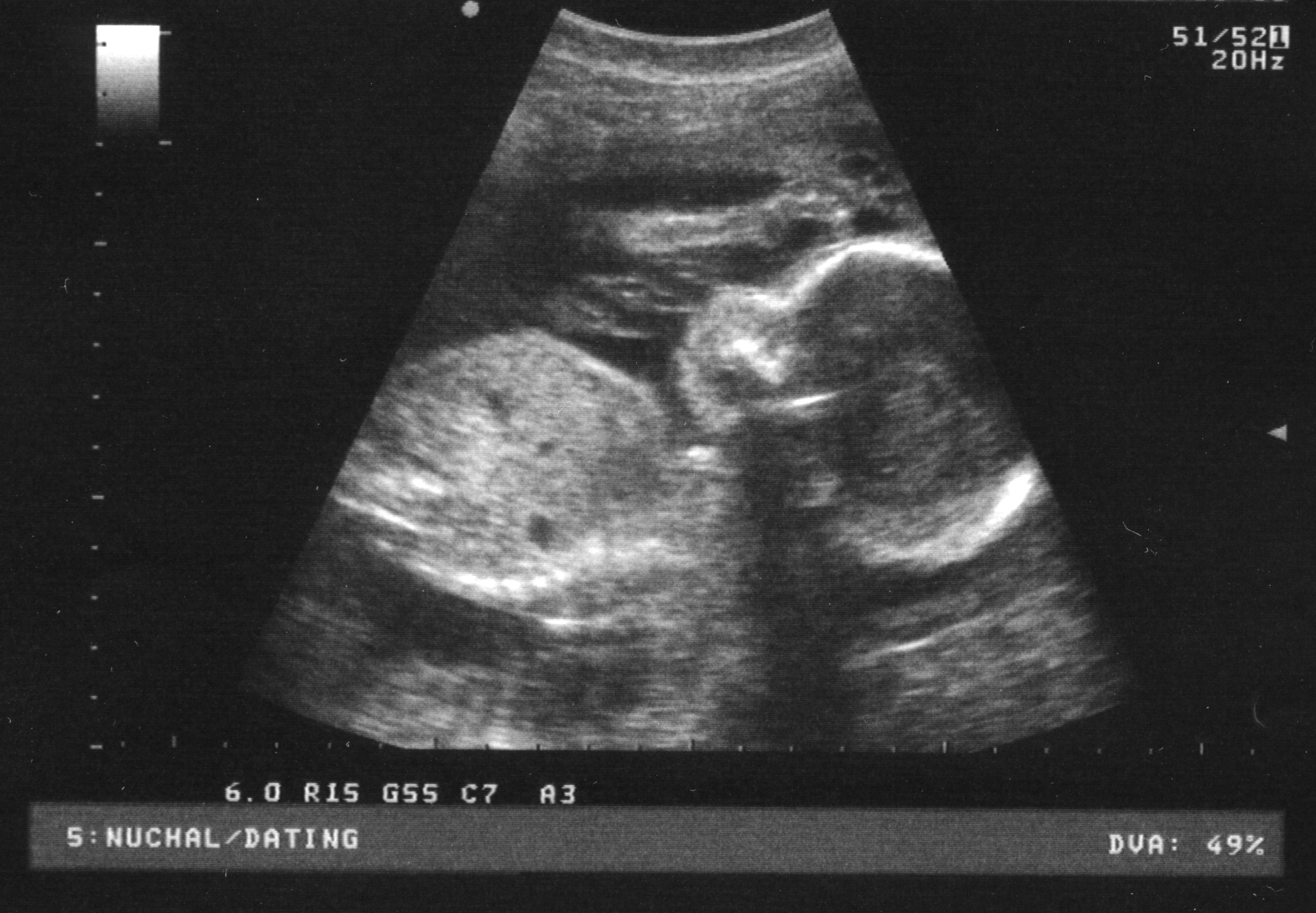 Twin babies ultrasound image.