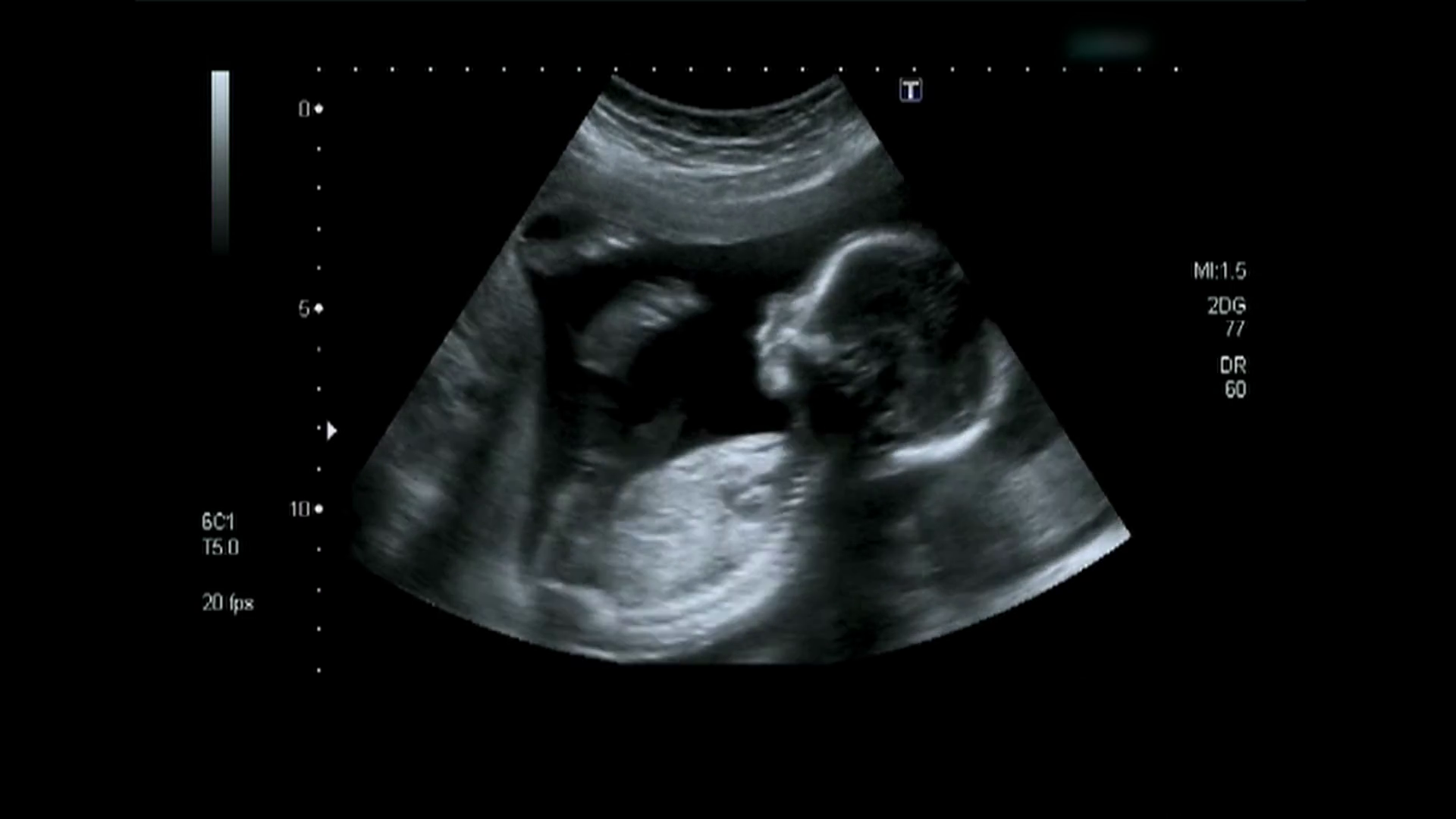 Ultrasound Of Baby Body In Motheru0027S Womb Stock Video Footage   Videoblocks - Baby Ultrasound, Transparent background PNG HD thumbnail