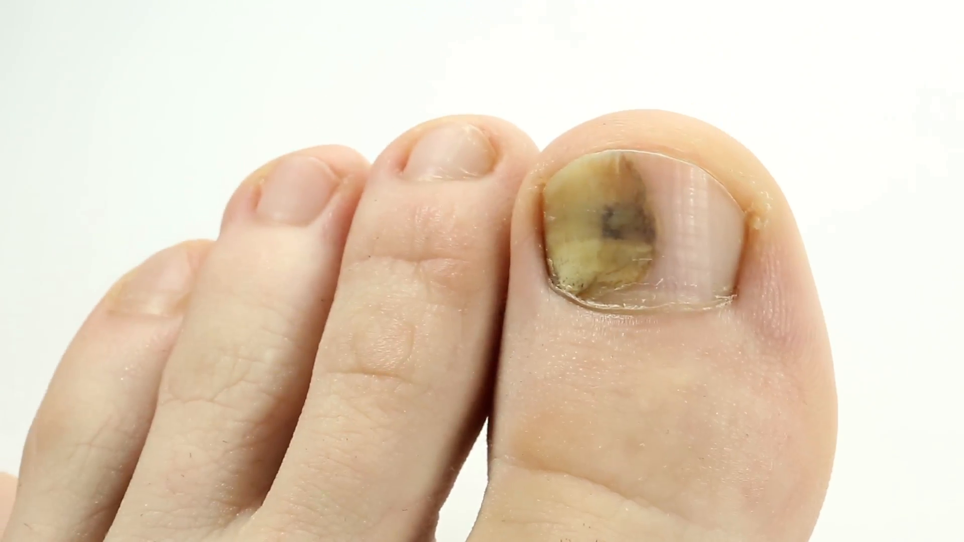 Fungi Toes. Fungus Of Big Toe. Bruise Under The Nail Of Big Toe. Injury To Nail. Sick Nail. Subungual Hematoma. Separation Of The Nail From Hdpng.com  - Big Toe, Transparent background PNG HD thumbnail