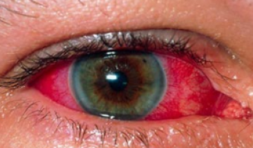 Also Smoking Weed Causes The Blood Vessels Inside Eyes To Dilate, The Increased Flow Of Blood In The Eyes Is What Causes Your Eyes To Appear Red. - Bloodshot Eyes, Transparent background PNG HD thumbnail