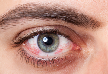 Causes Of Red Eye - Bloodshot Eyes, Transparent background PNG HD thumbnail