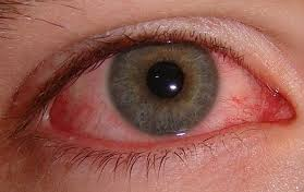 File:bloodshot Eye.png - Bloodshot Eyes, Transparent background PNG HD thumbnail