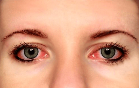 Red Veins in eyes causes