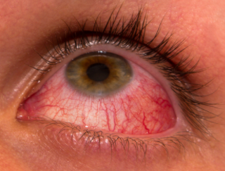 Red Veins In Eyes Causes - Bloodshot Eyes, Transparent background PNG HD thumbnail