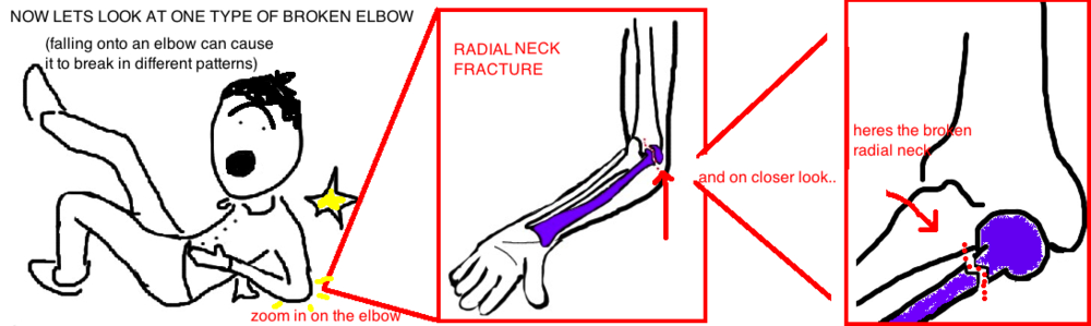 pediatric radial neck fractur