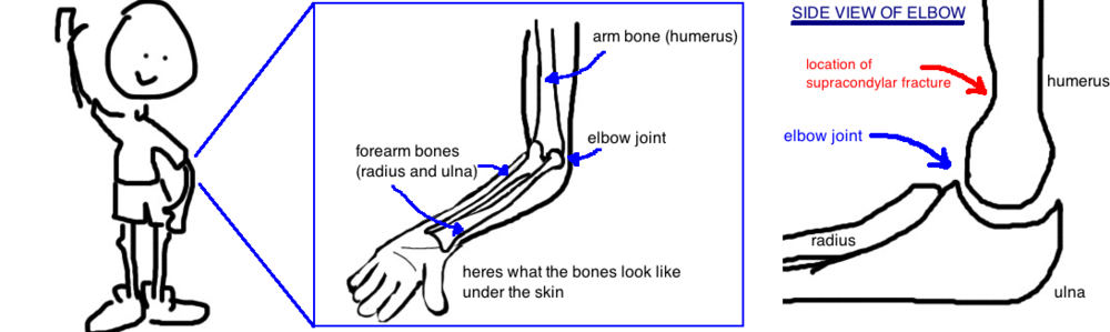 Broken Elbow Png - Pediatric Supracondylar Fracture, Transparent background PNG HD thumbnail