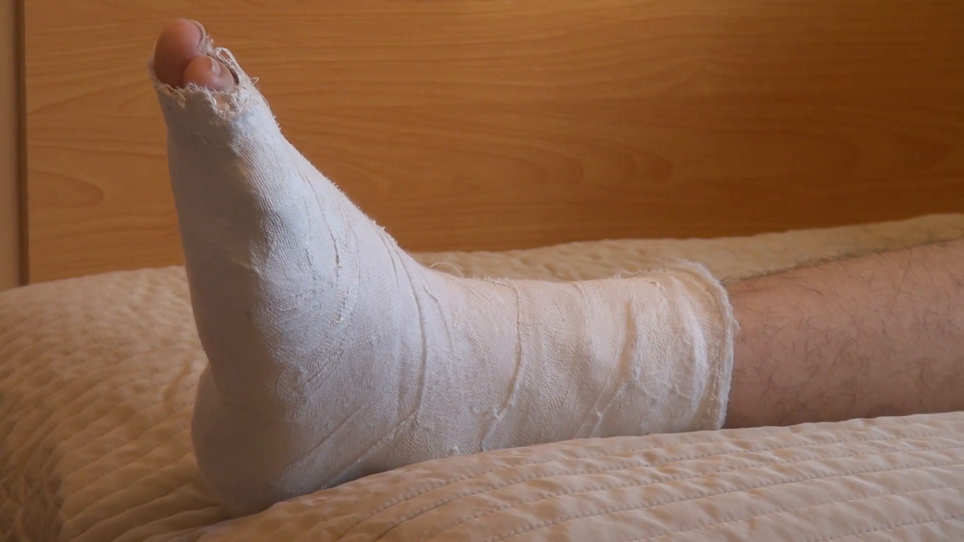 Little Girl With Broken Leg In Plaster Cast Stock Video Footage . - Broken Leg, Transparent background PNG HD thumbnail