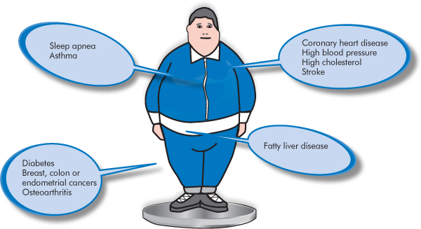 Health Risks Of Childhood Obesity - Childhood Obesity, Transparent background PNG HD thumbnail
