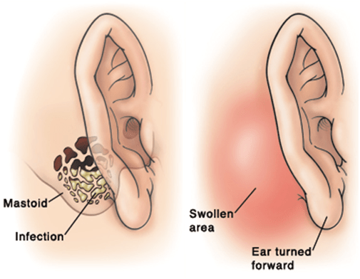 disease, ear, infection, pain