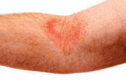 Dealing With Eczema Embarrassment - Eczema, Transparent background PNG HD thumbnail
