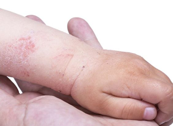 Eczema images atopic dermatit