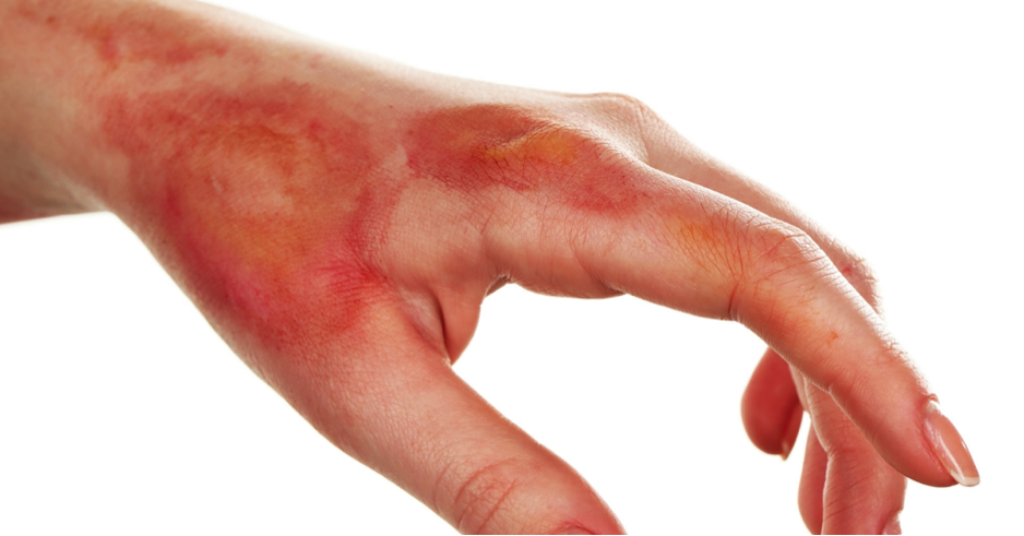 Eczema Causes - Eczema, Transparent background PNG HD thumbnail