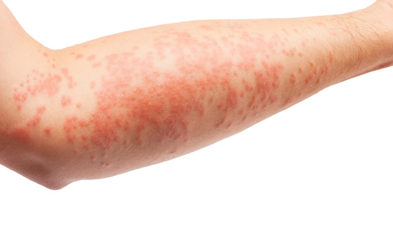 Eczema Is A Fairly Common Chronic Skin Condition Characterized By Dry, Itchy, Red And Inflamed Rashes That Can Occur Anywhere On The Scalp, Face And Body. - Eczema, Transparent background PNG HD thumbnail