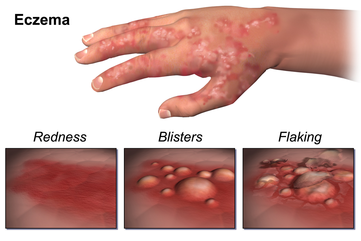 Dealing with Eczema Embarrass