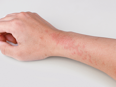 Over Time, Affected Patches Of Skin May Become Thick And Dark; These Patches Can Itch All The Time, Even Without An Eczema Flare. - Eczema, Transparent background PNG HD thumbnail