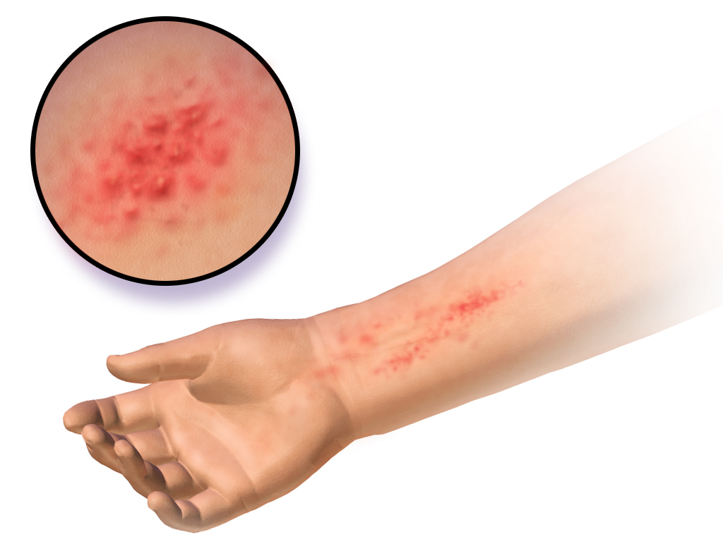 What Is Dermatitis - Eczema, Transparent background PNG HD thumbnail