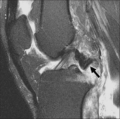 4U201459 Year Old Woman With Knee Pain After Motor Vehicle Crash. Sagittal Fat Suppressed T2  Weighted Mr Image (Tr/te, 4,000/70) Of Posterior Cruciate Ligament Hdpng.com  - Fat Woman With Knee Pain, Transparent background PNG HD thumbnail