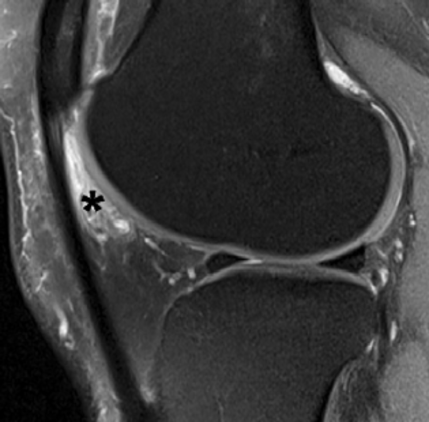 Sagittal Proton Densityu2013Weighted Fat  Suppressed Mr Image In 42 Year Old - Fat Woman With Knee Pain, Transparent background PNG HD thumbnail