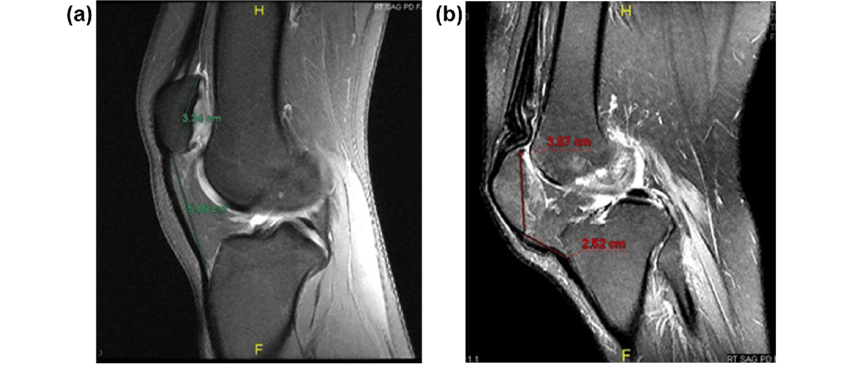 Sagittal T2 Fat Sat Image In A 20 Year Old Female Complaining Of Knee Pain With An Insal Salvati Ratio Of 1.7. (B) Patella Baja. - Fat Woman With Knee Pain, Transparent background PNG HD thumbnail