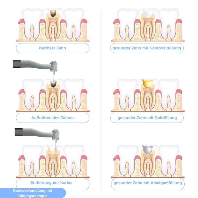 Das Ziel Der Füllungstherapie - Gesunder Zahn, Transparent background PNG HD thumbnail