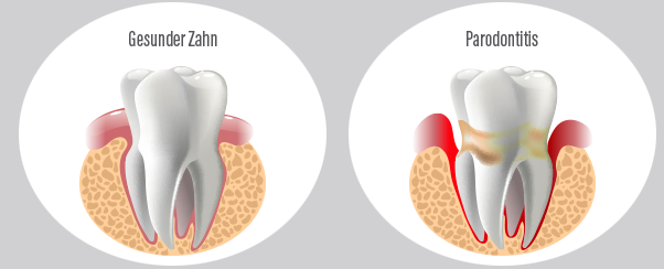 Gesunder Zahn / Parodontitis - Gesunder Zahn, Transparent background PNG HD thumbnail