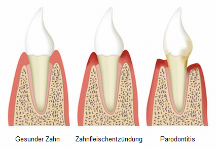Gesunder Zahn / Parodontitis