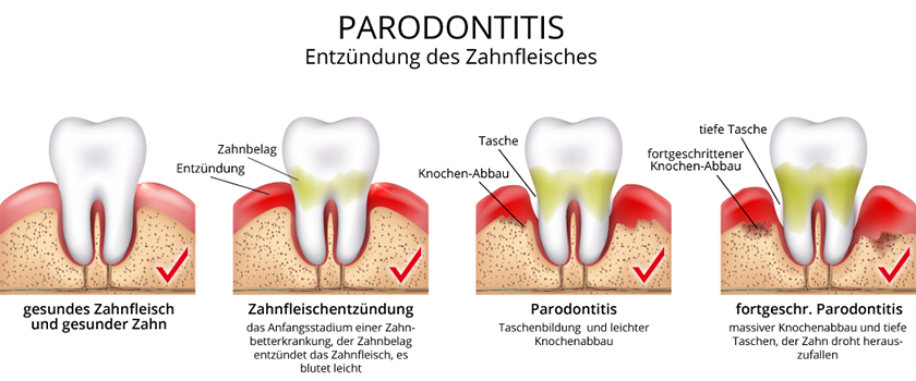 Parodontologie - Gesunder Zahn, Transparent background PNG HD thumbnail