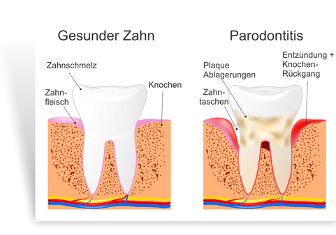 Parodontose Behandlung Zahnarzt Bingen - Gesunder Zahn, Transparent background PNG HD thumbnail