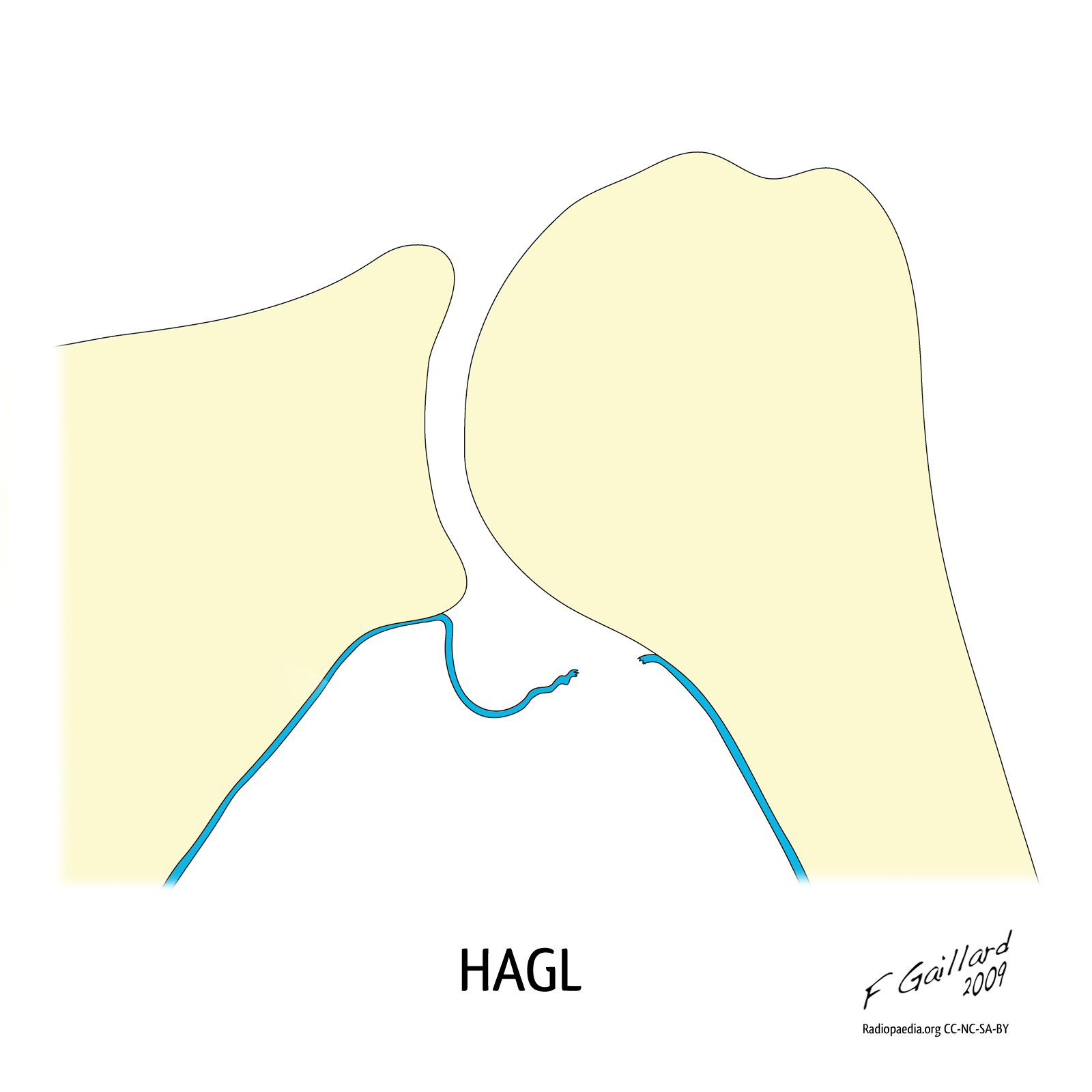 View Full Size Version Of Humeral Avulsion Of Glenohumeral Ligament: Diagram - Hagl, Transparent background PNG HD thumbnail
