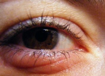 Red itchy eyes symptoms