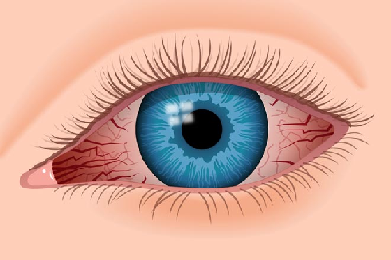 Itchy Eyes Png - Macular Degeneration: Itchy, Red Eyes?, Transparent background PNG HD thumbnail