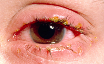 Itchy Eyes Png - Red Itchy Eyes Symptoms, Transparent background PNG HD thumbnail