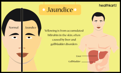 Jaundice ( پیلا یرقا