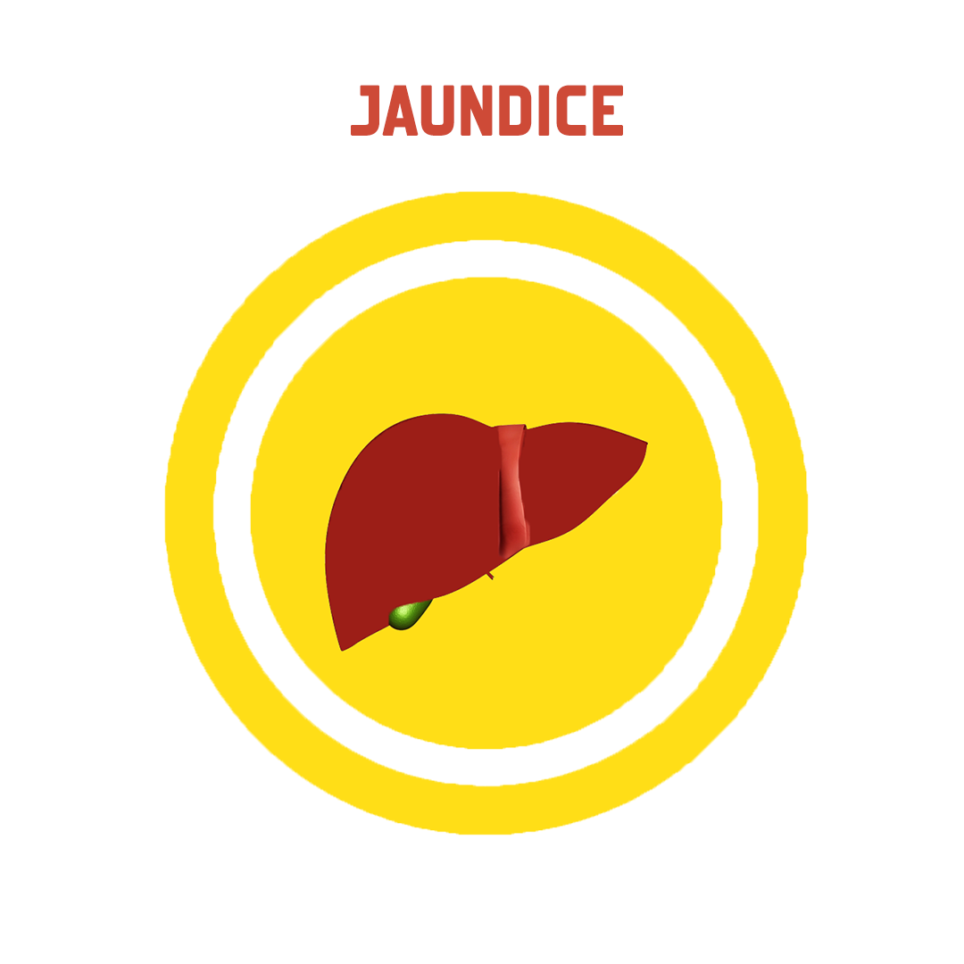 Jaundice - Jaundice, Transparent background PNG HD thumbnail