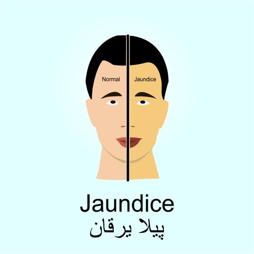 Jaundice ( پیلا یرقان ) - Jaundice, Transparent background PNG HD thumbnail