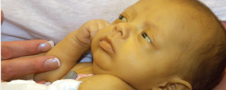 Neonatal Jaundice - Jaundice, Transparent background PNG HD thumbnail