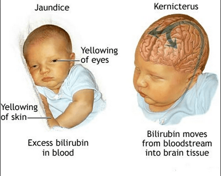File:Neonatal jaundice.png