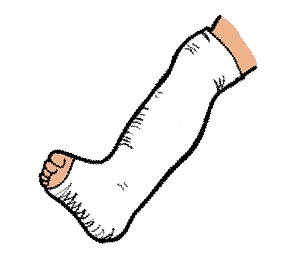 Orthopedic Leg Cast Object