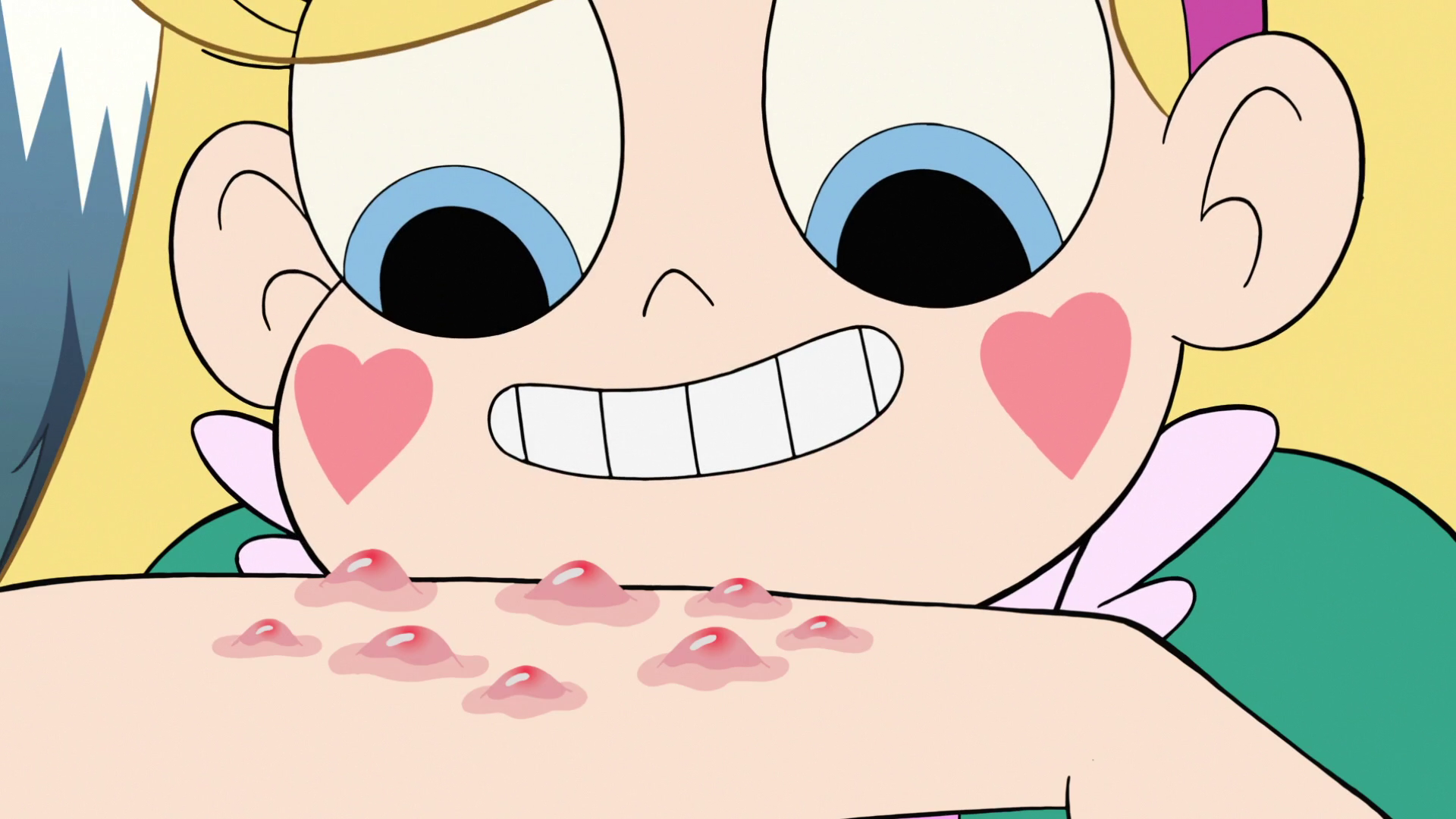 Image   S2E10 Star Butterfly Looks At Her Mosquito Bites.png | Star Vs. The Forces Of Evil Wiki | Fandom Powered By Wikia - Mosquito Bite, Transparent background PNG HD thumbnail