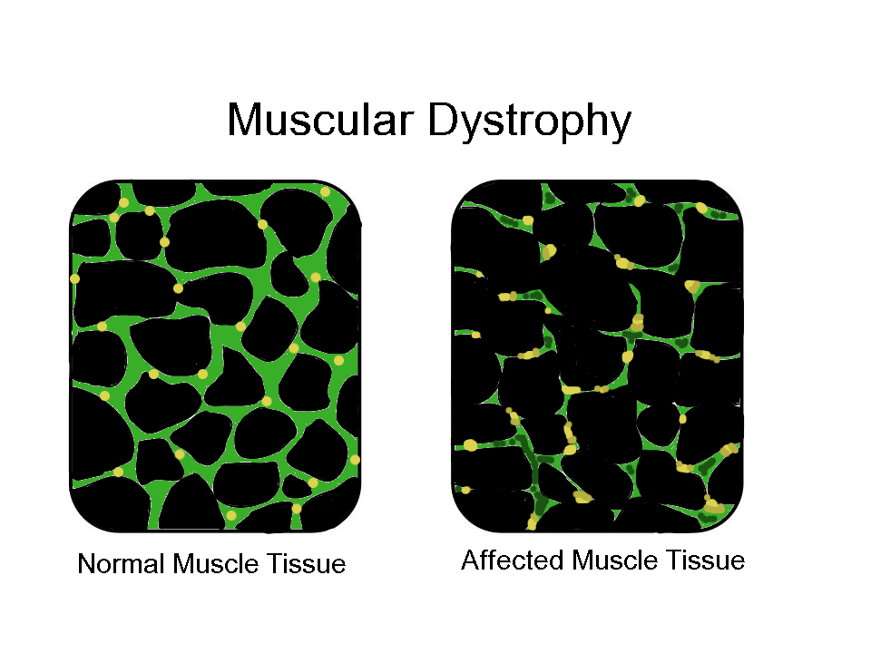 Muscular Dystrophy Png Hdpng.com 960 - Muscular Dystrophy, Transparent background PNG HD thumbnail